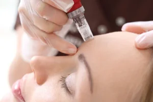 Benefits of SkinPen® Microneedling