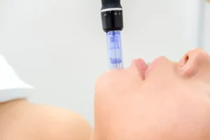 Med Spa in Reading, PA Offering SkinPen® Microneedling