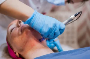 RF Microneedling Treatment in Pottstown, PA