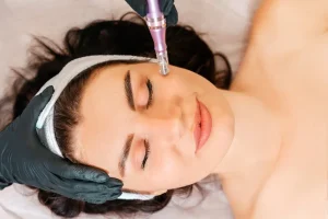 Sylfirm X RF Microneedling Near You Sylfirm X RF Microneedling Near You
