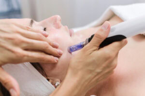 Microneedling Laureldale, PA Microneedling Laureldale, PA